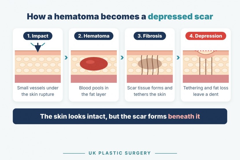How a hematoma becomes a depressed scar