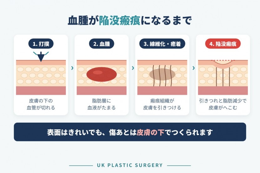 血腫が陥没瘢痕になるまで