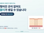 상처가 없었는데 얼굴이 꺼졌어요 — 혈종이 남기는 함몰 흉터