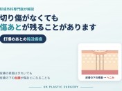 センタム美容外科・UK美容外科 切り傷がないのに顔がへこんだ？血腫が残す陥没瘢痕